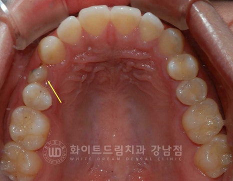 영구치 결손, "유치가 흔들려요." 성인 잔존 유치 발치 후 바로 임플란트 식립! 관련 이미지 10