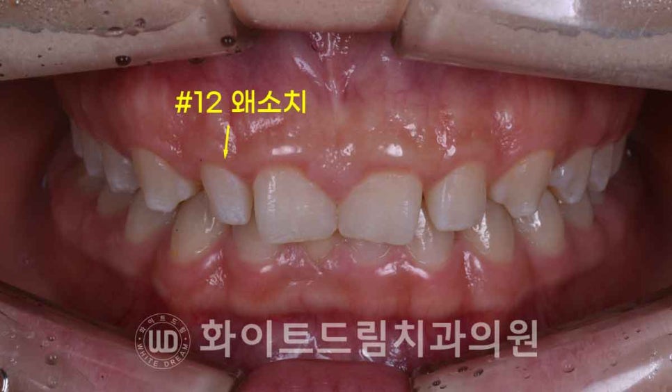 강남역 잇몸성형, 라미네이트와 흔히 동반되는 관련 이미지 4