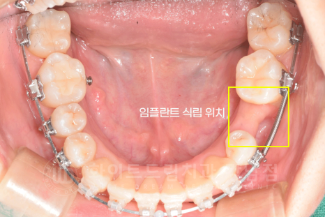 강남 덧니 비발치교정 / 임플란트와 치아교정 동시 진행 case 리뷰. 관련 이미지 12