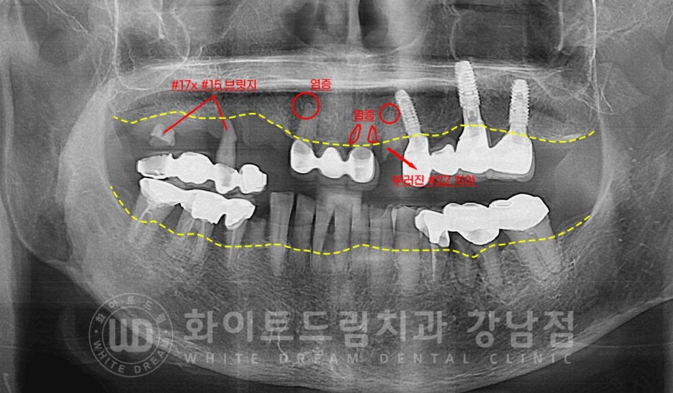 임플란트 1차 수술, 2차 수술이란 무엇일까? (+ 상악 전체 임플란트 치료 기간) 관련 이미지 4