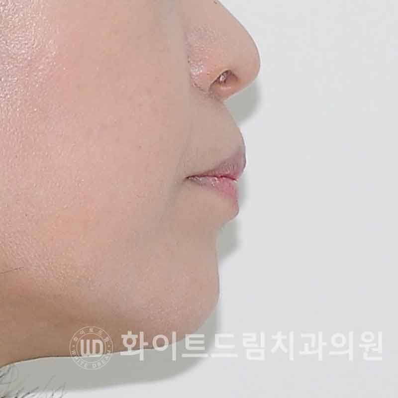 서울전체임플란트 / "경상도에서 왔어요." 치주염으로 인한 앞니 돌출 치료 (+서울전체임플란트 내원 횟수는?) 관련 이미지 8