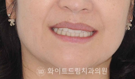 서울전체임플란트 / "경상도에서 왔어요." 치주염으로 인한 앞니 돌출 치료 (+서울전체임플란트 내원 횟수는?) 관련 이미지 6