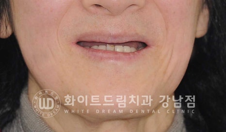 상악 풀케이스임플란트 사례 "부산에서 강남까지 왔어요" 관련 이미지 4