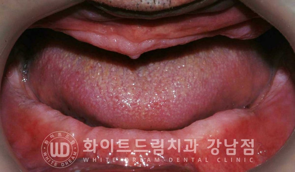 전체 임플란트 치료 기간과 수술 후 나타나는 변화는? 관련 이미지 4