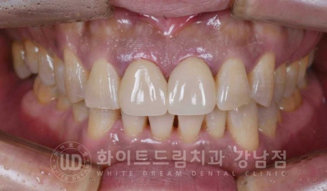 벌어지고 깨진 앞니, 웨딩 앞니 라미네이트 치료 사례 "남자도 자연스럽게 라미네이트 가능한가요?" 관련 이미지 5