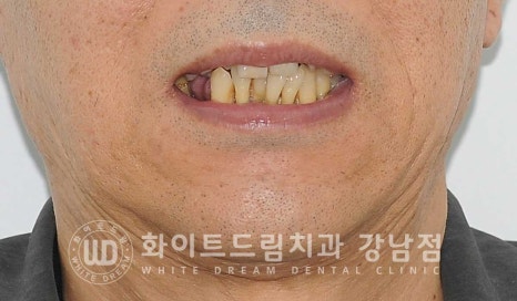 강남역 전악임플란트치과 / 치주 질환이 치아와 임플란트에 끼치는 영향! 관련 이미지 1
