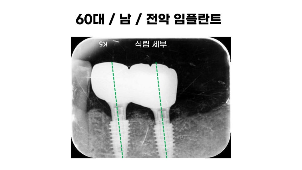 60대 전악임플란트후기 및 치료기간 관련 이미지 8