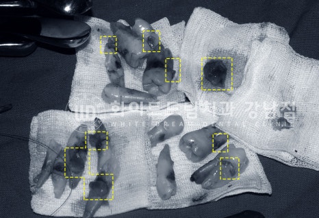 40대 전체임플란트 / 디지털스캔바디를 이용한 전체 임플란트 치료 사례 (Feat. 치주염) 관련 이미지 14