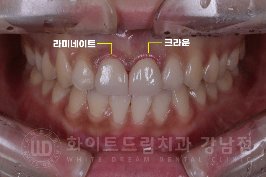 강남역 주변 치과 "10년 된 앞니가 변색됐어요" 앞니 심미 치료 관련 이미지 9