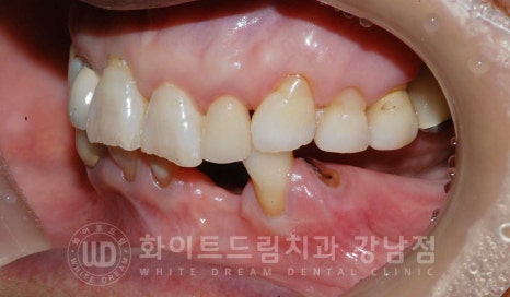 잇몸뼈가 없다는 게 무슨 말일까? "틀니를 오래 사용해서 잇몸뼈가 없대요" 임플란트 잘하는 강남치과 관련 이미지 17
