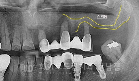 임플란트 재수술의 주원인, "임플란트 주위염과 임플란트 찢어짐!" 관련 이미지 13