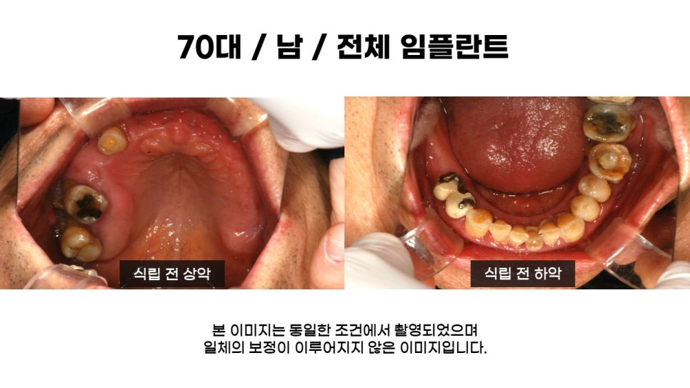 고연령 전체임플란트 과정 및 임플란트 치료기간, 전체임플란트식립후기 관련 이미지 2