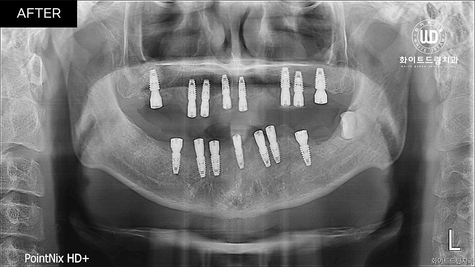 전체임플란트 식립 및 임플란트뼈이식 후기 관련 이미지 5