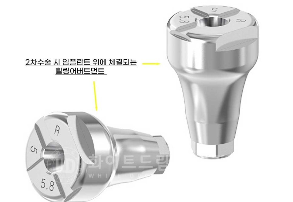 임플란트 1차 수술, 2차 수술이란 무엇일까? (+ 상악 전체 임플란트 치료 기간) 관련 이미지 11