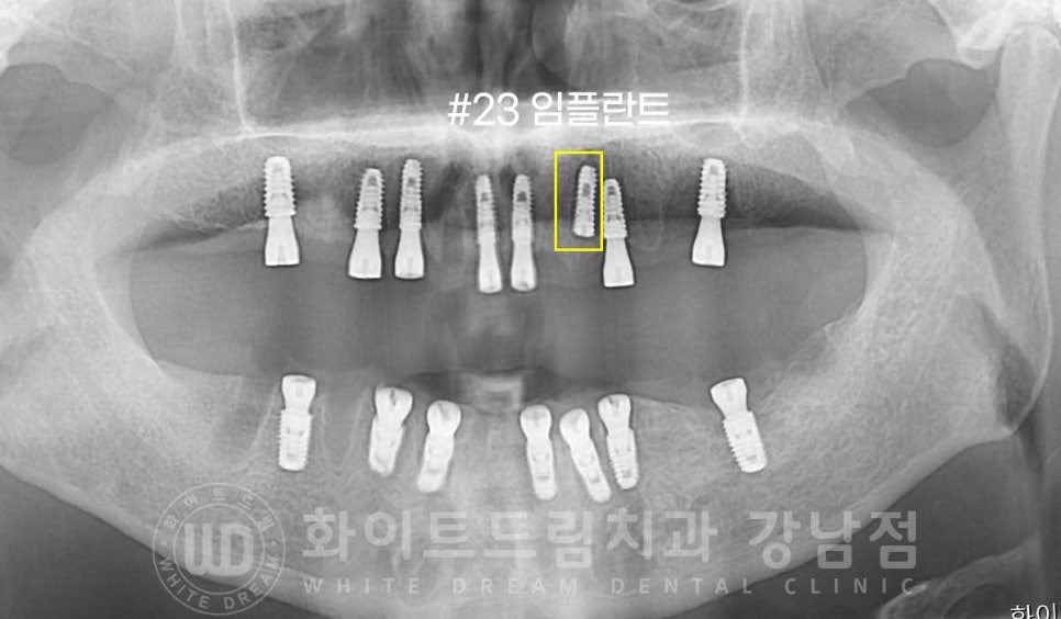 전체 임플란트 치료 기간과 내원 횟수는? "치과에 자주 가기 어려워요." 관련 이미지 15