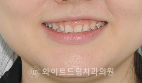 강남역 잇몸성형, 라미네이트와 흔히 동반되는 관련 이미지 13