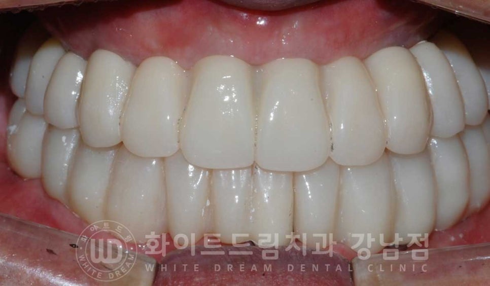 전체 임플란트 치료 기간과 내원 횟수는? "치과에 자주 가기 어려워요." 관련 이미지 23