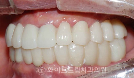 서울전체임플란트 / "경상도에서 왔어요." 치주염으로 인한 앞니 돌출 치료 (+서울전체임플란트 내원 횟수는?) 관련 이미지 16