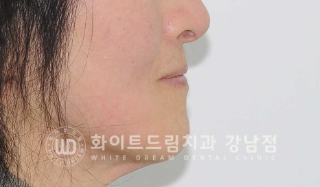 상악 풀케이스임플란트 사례 "부산에서 강남까지 왔어요" 관련 이미지 22