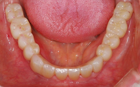 임플란트 하기 전 알아보아야 할 것. 관련 이미지 19