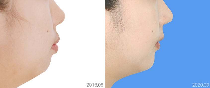 얼굴공개없는 치아교정 모델 모집 관련 이미지 12