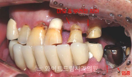 서울전체임플란트잘하는치과, 왜 치주염이 심해지면 반대교합까지 생길까요? (치주염 전체 임플란트 CASE) 관련 이미지 5