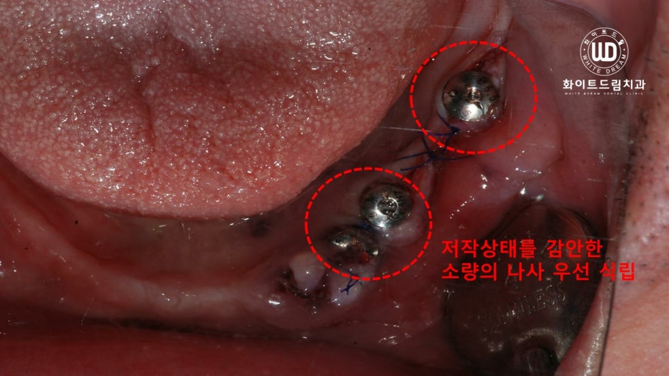 전체 치조골 이식을 동반한 고혈압 환자 임플란트 사례 관련 이미지 5