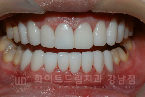 강남역 앞니라미네이트 "틀어진 토끼 앞니 빠르게 개선" 강남역 라미네이트 치과 관련 이미지 5