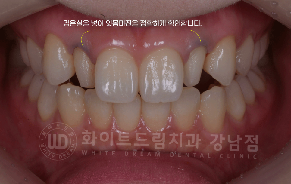 강남역 심미치과 "치아 하나가 유난히 작아요" #왜소치라미네이트 관련 이미지 7