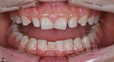 강남역 라미네이트 "치아가 작고 벌어졌어요" 거미스마일 + 벌어진 치아 개선 관련 이미지 11