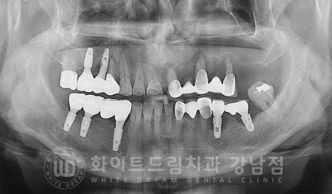 임플란트 재수술의 주원인, "임플란트 주위염과 임플란트 찢어짐!" 관련 이미지 16