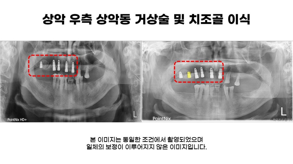 어금니임플란트 수복 및 당뇨환자임플란트 가격, 종류, 통증 관련 이미지 6