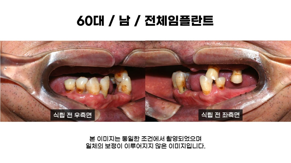 어금니임플란트 수복 및 당뇨환자임플란트 가격, 종류, 통증 관련 이미지 2