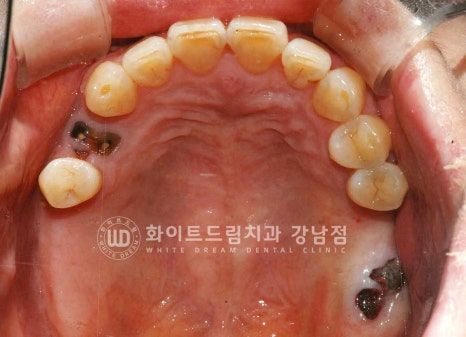 신경치료 후 크라운을 해야 하는 이유 / 크라운을 안 해 부러진 치아 임플란트 치료 case 관련 이미지 17