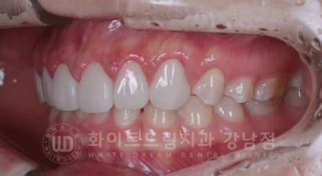 강남역 라미네이트 "치아가 작고 벌어졌어요" 거미스마일 + 벌어진 치아 개선 관련 이미지 14