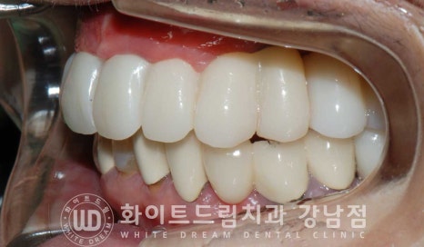 상악 풀케이스임플란트 사례 "부산에서 강남까지 왔어요" 관련 이미지 16
