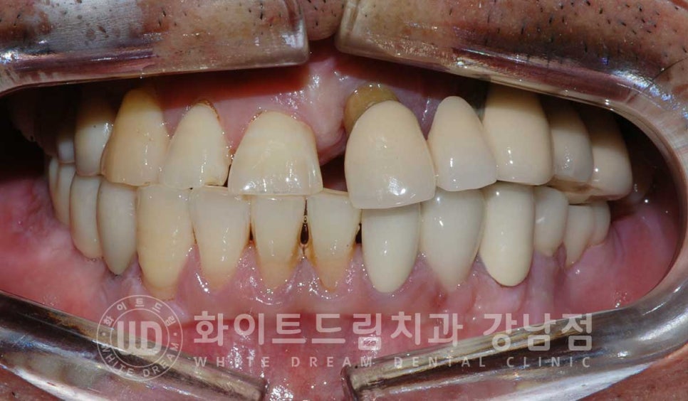 임플란트 재수술의 주원인, "임플란트 주위염과 임플란트 찢어짐!" 관련 이미지 1