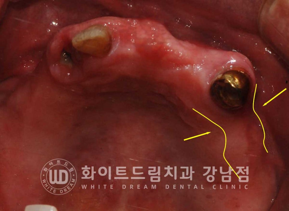 전체 임플란트 치료 기간과 내원 횟수는? "치과에 자주 가기 어려워요." 관련 이미지 11
