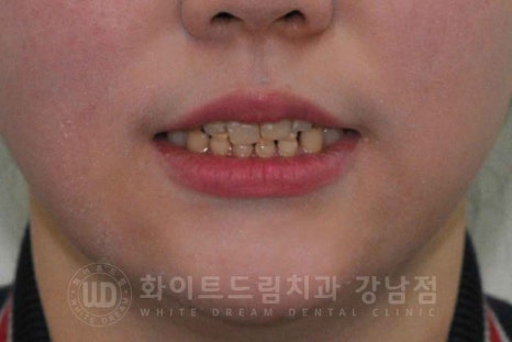 법랑질형성부전증, 라미네이트로 개선해요! / 강남역 라미네이트 치과 관련 이미지 8