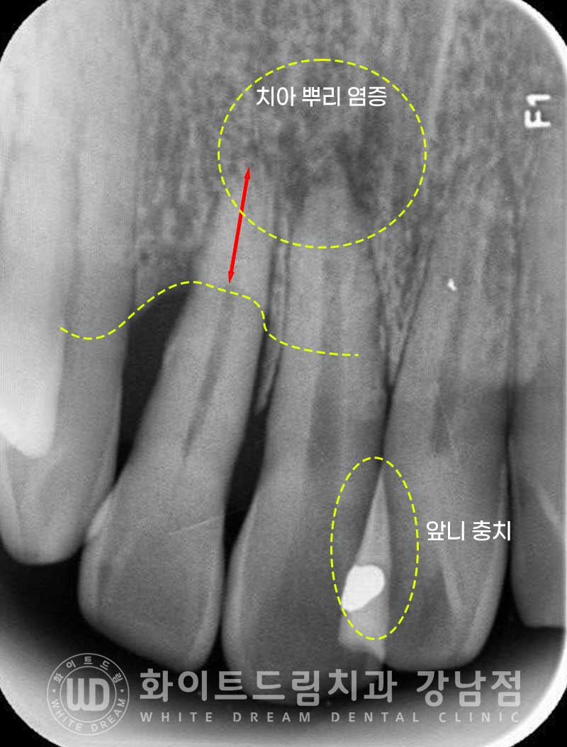 사고당한 앞니치료, "흔들리고 점점 변색돼요." 앞니 임플란트 & 신경치료 관련 이미지 6