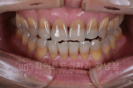 강남역 인근 치과 / 테트라사이클린(tetracycline) 치아 변색 / 라미네이트로 개선! 관련 이미지 11