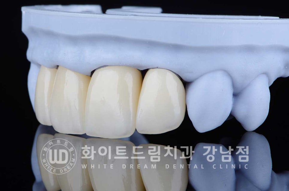 벌어진 앞니라미네이트 / "왜소치로 치아가 벌어졌어요" 치료 사례 관련 이미지 5