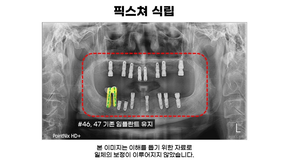 전악 임플란트 과정 및 후기 전후사례확인하고 임플란트가격 비용 알아보기 관련 이미지 3