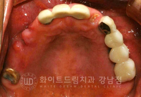 임플란트 1차 수술, 2차 수술이란 무엇일까? (+ 상악 전체 임플란트 치료 기간) 관련 이미지 12