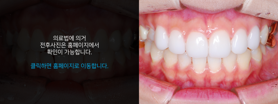 라미네이트 치료에 대해 알아보면? 관련 이미지 17