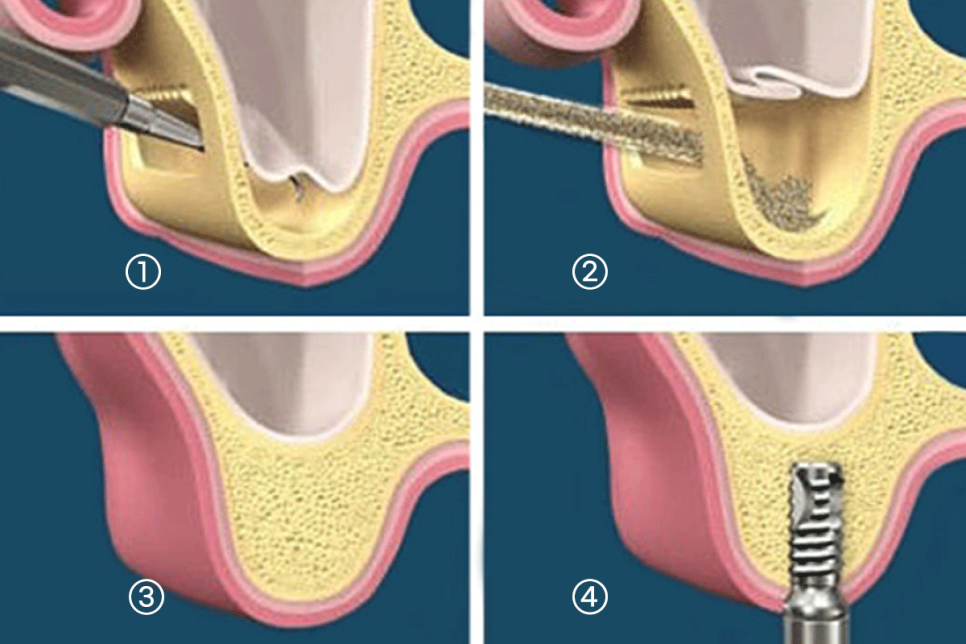 강남역 어금니 임플란트 "어금니가 부러졌어요" 상악동 거상술(lateral approach) 관련 이미지 6
