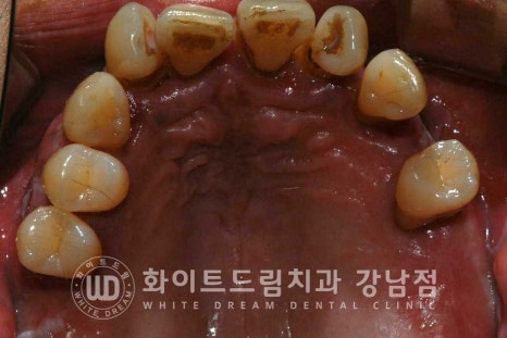강남역 전악임플란트치과 / 치주 질환이 치아와 임플란트에 끼치는 영향! 관련 이미지 12