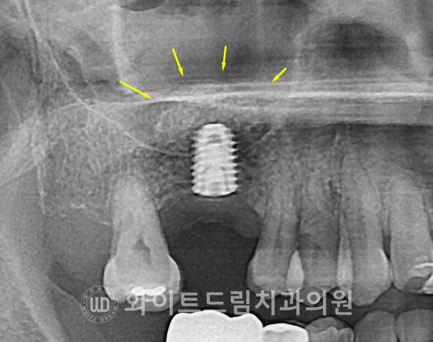 강남역어금니임플란트 치료 시 흔히 동반되는 상악동거상술 (Lateral window 방식), "잘 됐는지 어떻게 확인하죠?" 관련 이미지 11