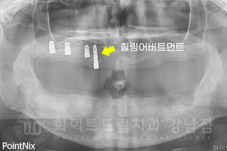 강남역 전체임플란트 치과 "치아가 심하게 흔들려요." 심한 치주염 임플란트 치료 관련 이미지 10
