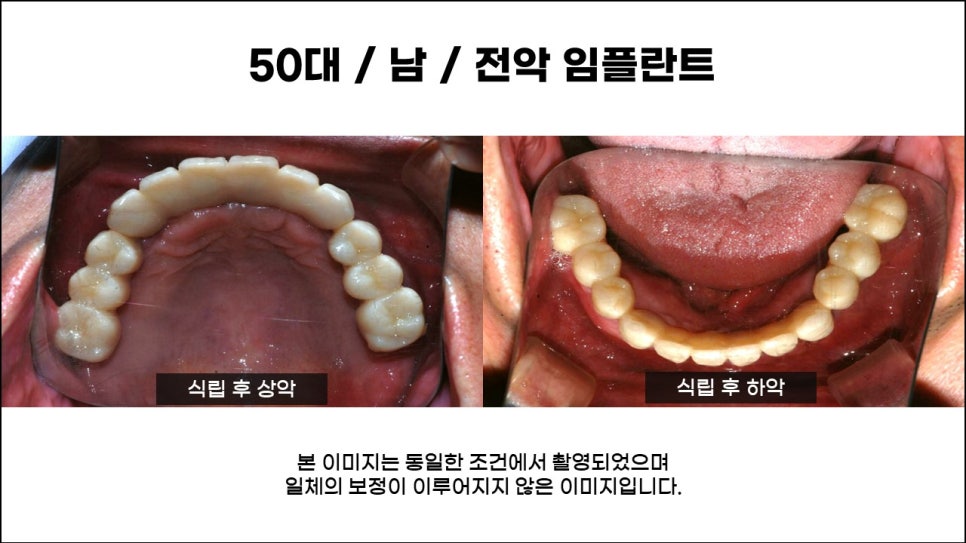 전체임플란트, 치료, 종류, 수술과정과 방법 관련 이미지 5